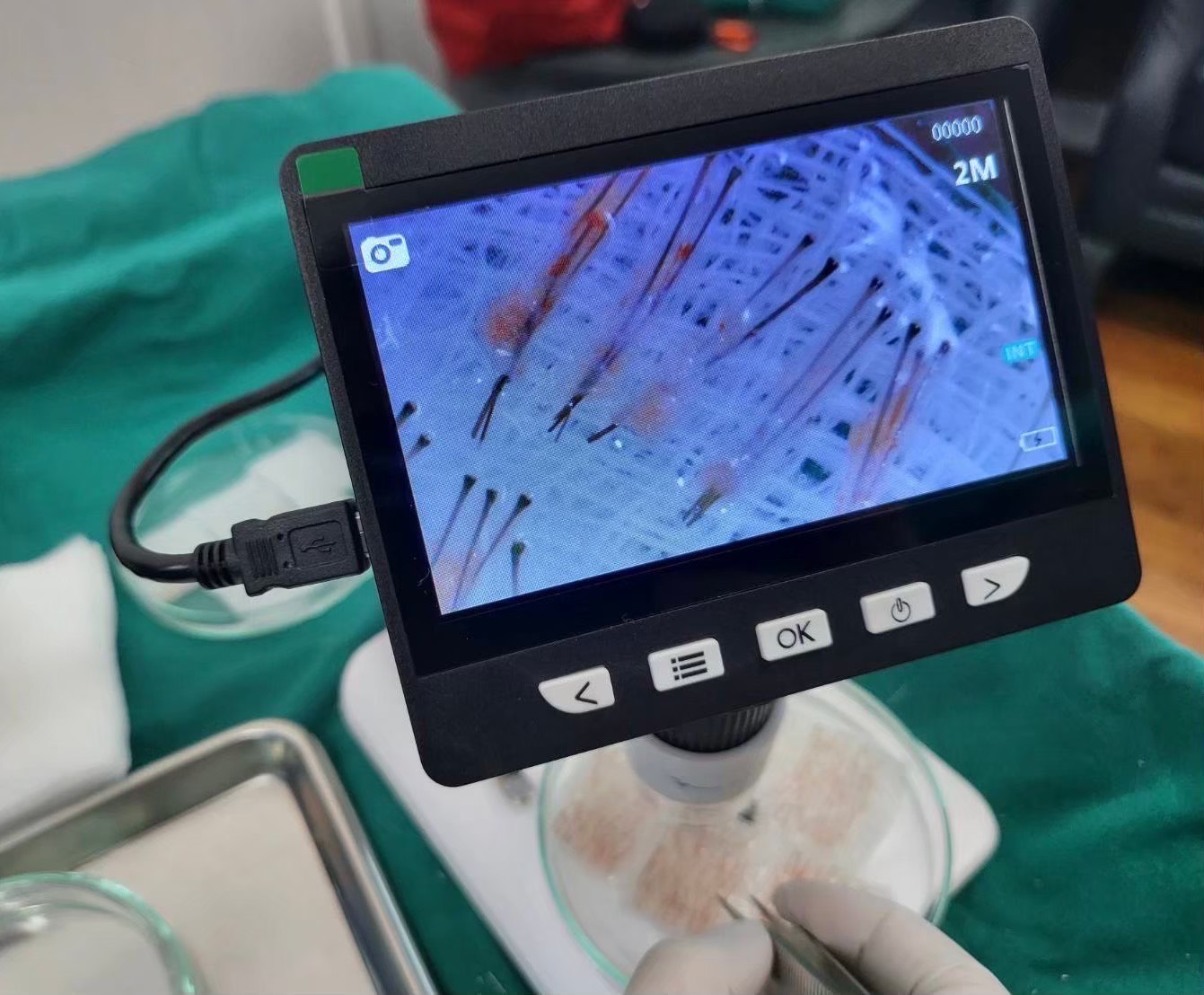 Hair Transplant in Pattaya I Menhance Clinic