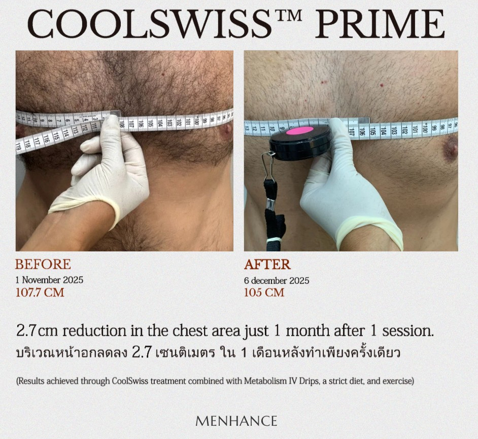 Before & After Testimonial of Cryolipolysis