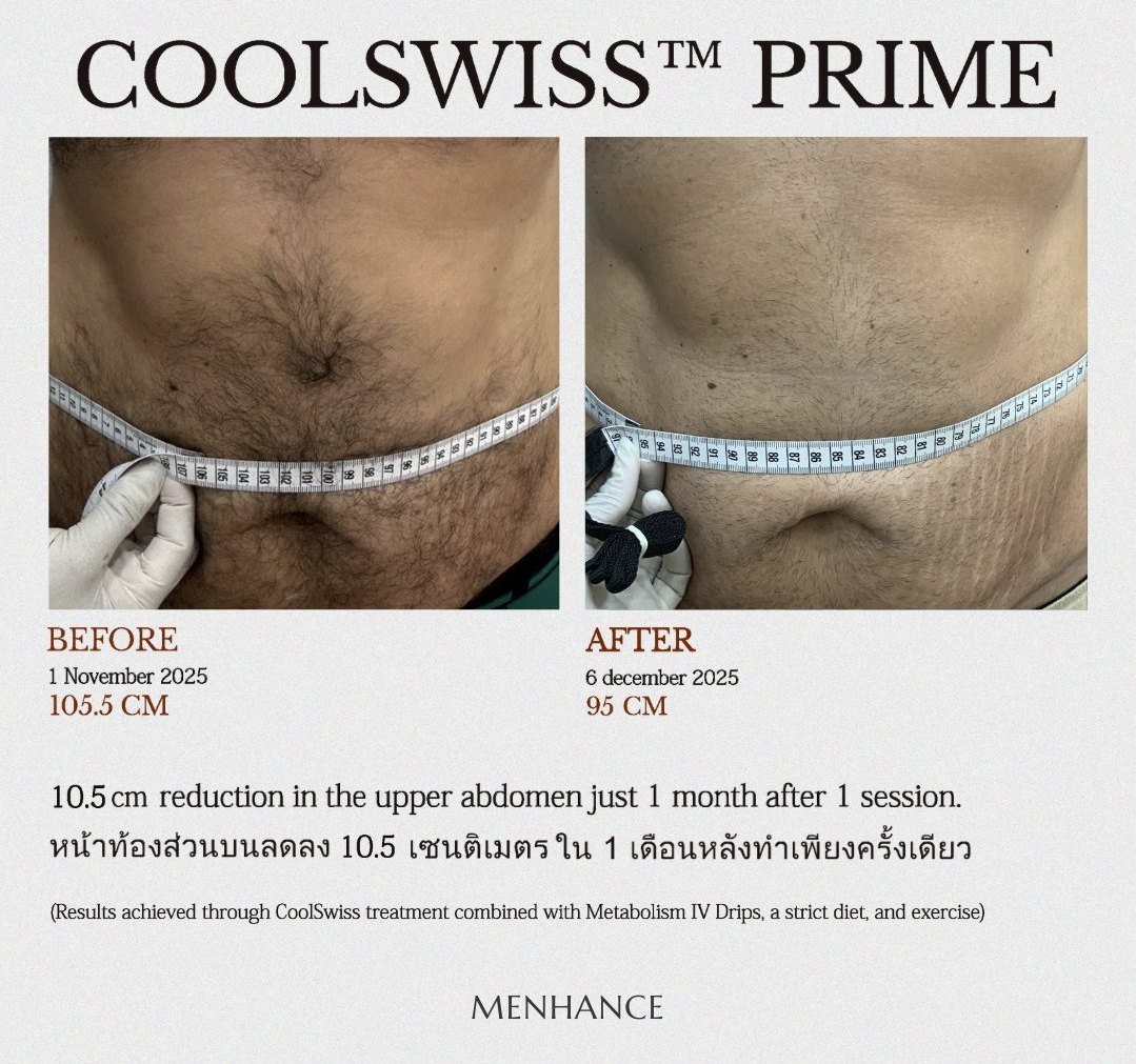 CoolSwiss Prime before and after — lower abdomen, 5 cm reduction