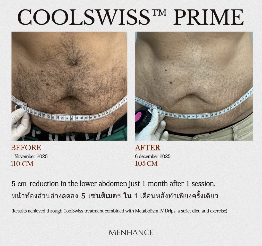 CoolSwiss Prime before and after — upper abdomen, 10.5 cm reduction