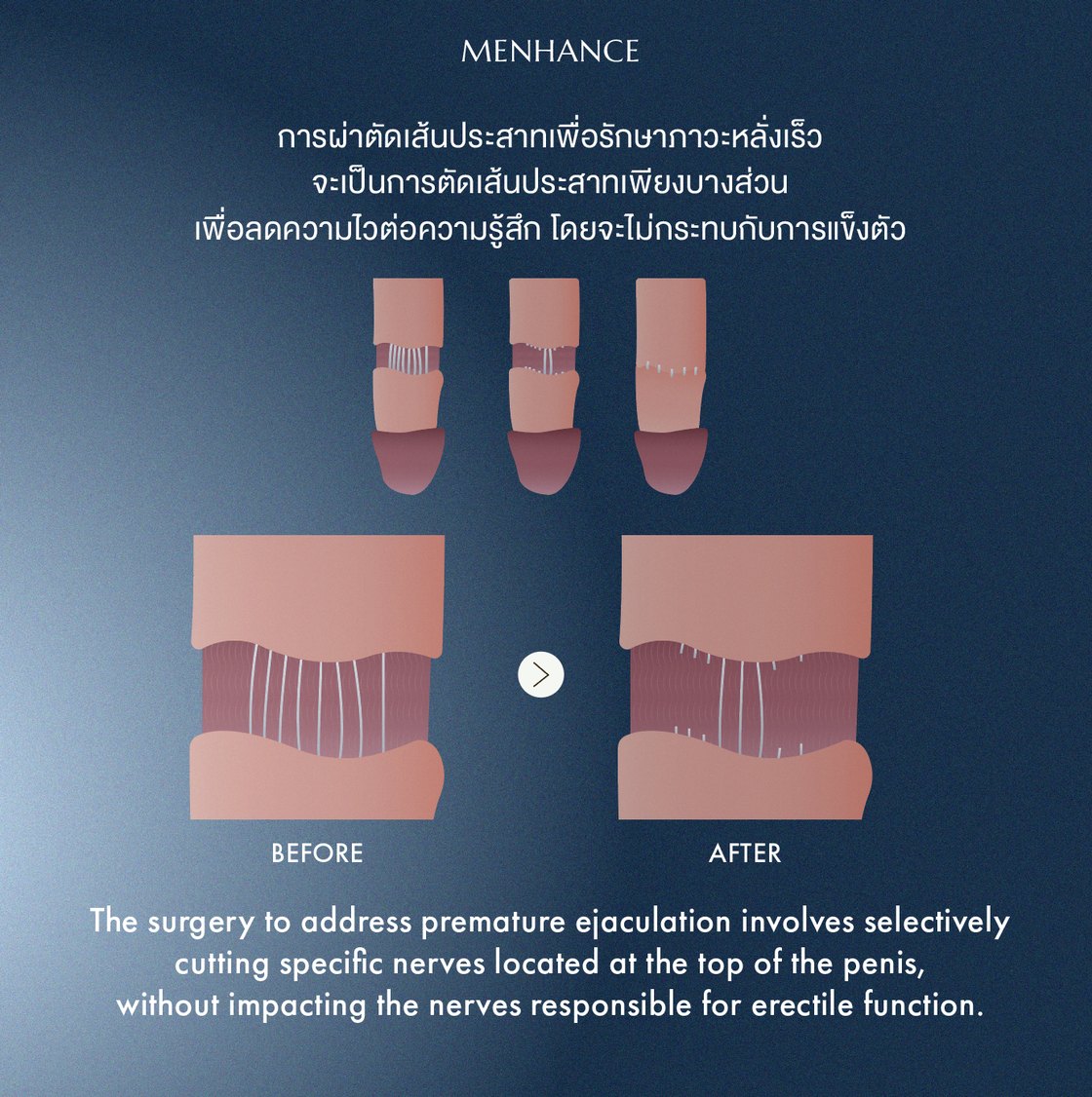 Selective dorsal neurectomy — selected sensory nerves on the top of the penis are divided to reduce sensitivity while the nerves responsible for erections are preserved